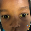 positive scleral icterus positive scleral icterus
