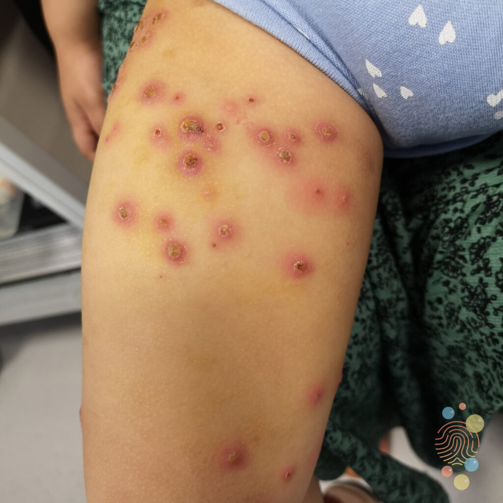 chicken pox virus