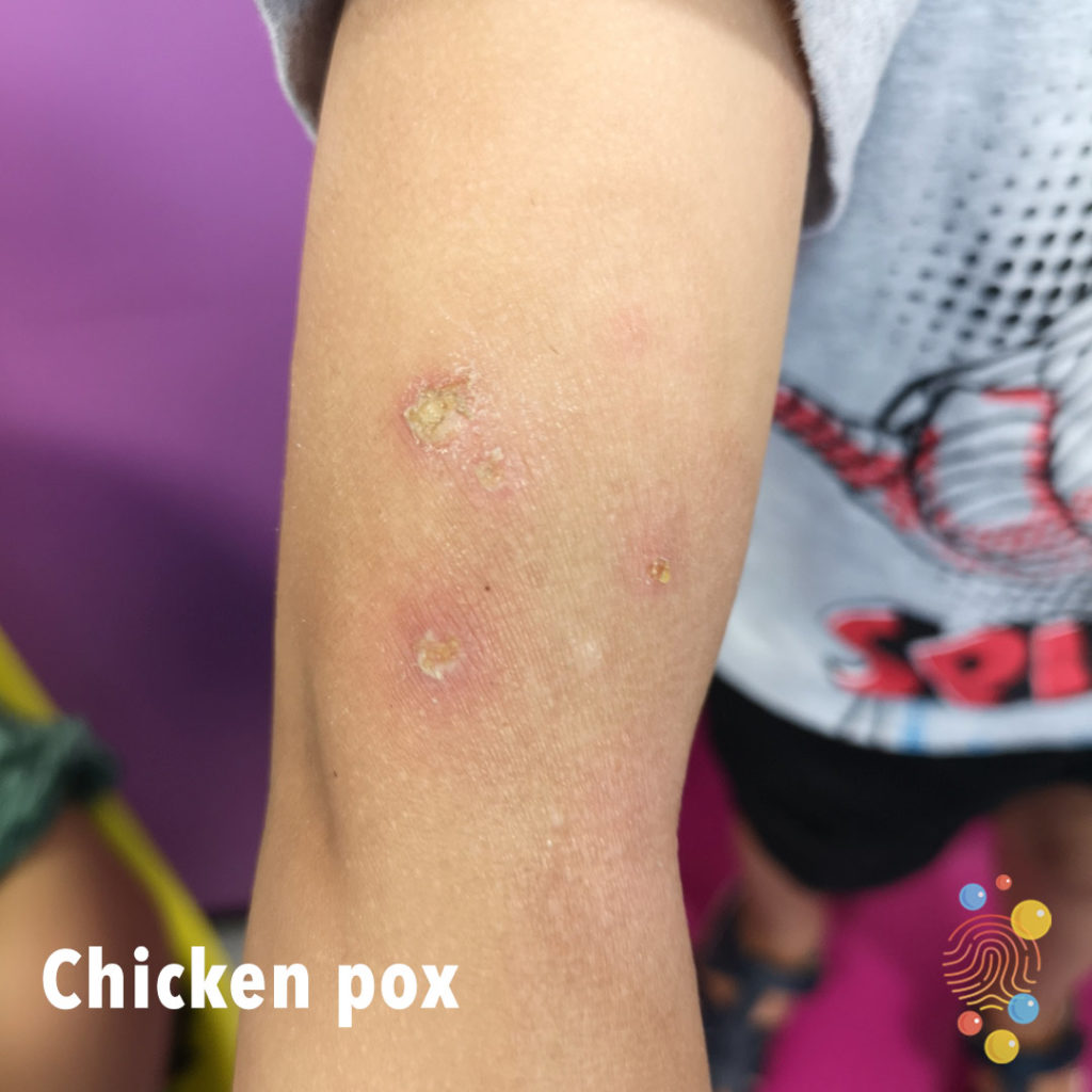 chicken pox virus