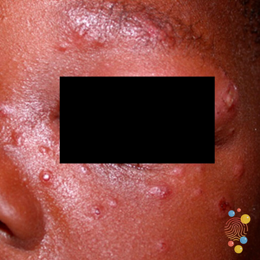 Pictures Of Herpes On Lips Infoupdate