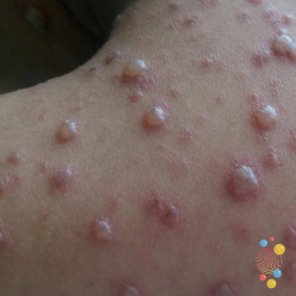 Chicken Pox Stages