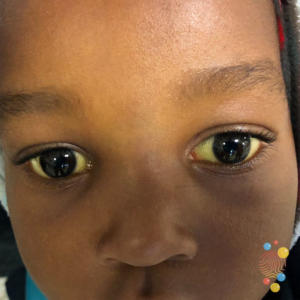 Jaundice neonatal Skin Deep